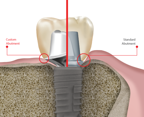 Custom Implant vs Standard Implant