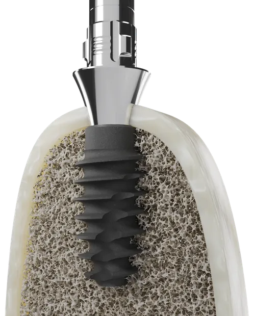 PACE implant with its prosthetic connection