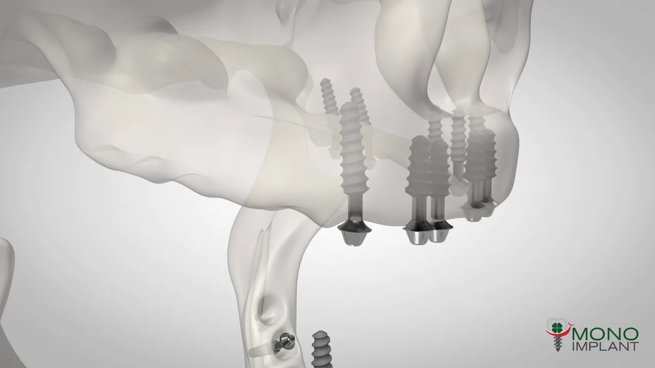 Monoimplant Multiunit implants placed in a full arch